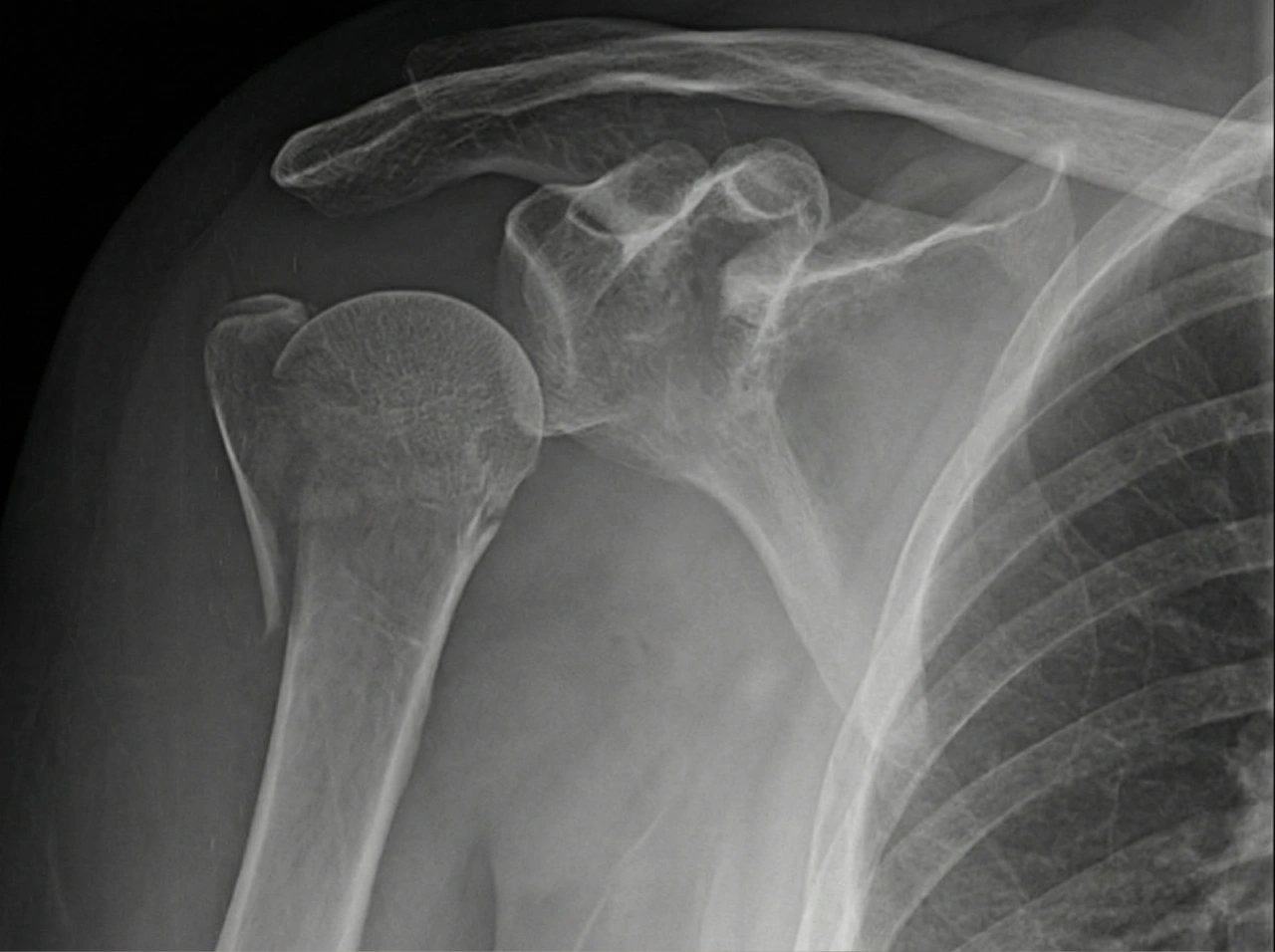 Radiografia do ombro