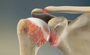 Artrose-ombro-tratamento-infiltracao-dor-ortopedista-joao-basmage-campo-grande