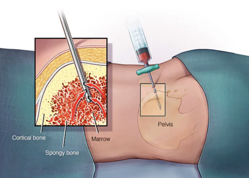 BMA na ortopedia – infiltração com medula óssea aspirada